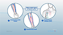 Dialysis Access